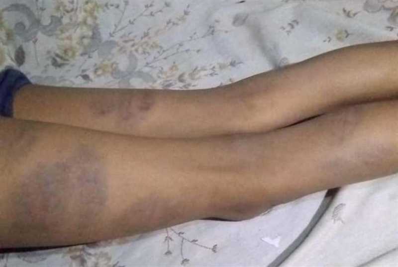 إب.. مدير مدرسة يعتدي على طالب بشكل وحشي بالعدين